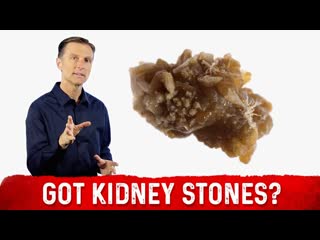 Treatment For Kidney Stone & Kidney Stone Prevention  Dr. Berg