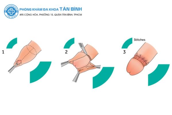 10 địa chỉ cắt bao quy đầu kín đáo, an toàn tại quận 10