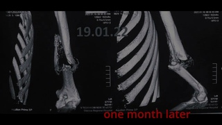 Консервативное лечение перелома 12В2. CONSERVATIVE TREATMENT OF 12B2 HUMERAL FRACTURE (ЧИТАЕМ ОПИС)
