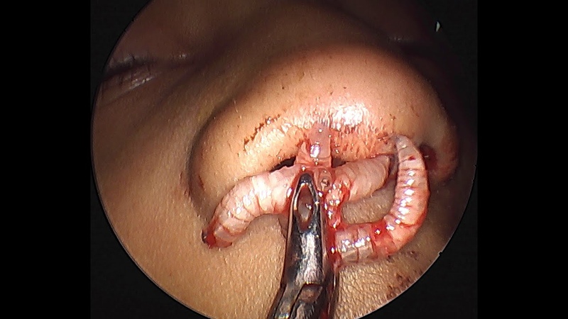MAGGOTS in a 5yr Old kid, Maggots eating healthy tissue inside